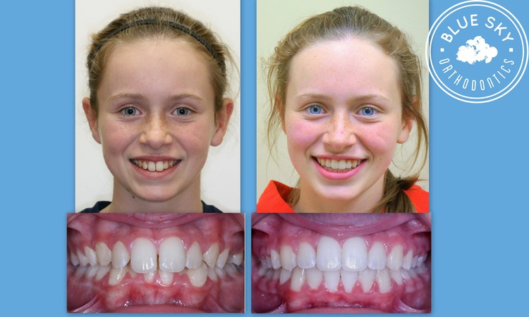 Before and After - Blue Sky Orthodontics